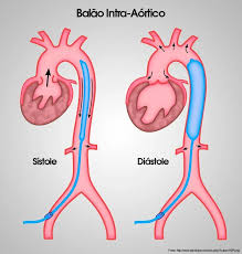 Balão Intra-Aórtico - Sístole e Diástole