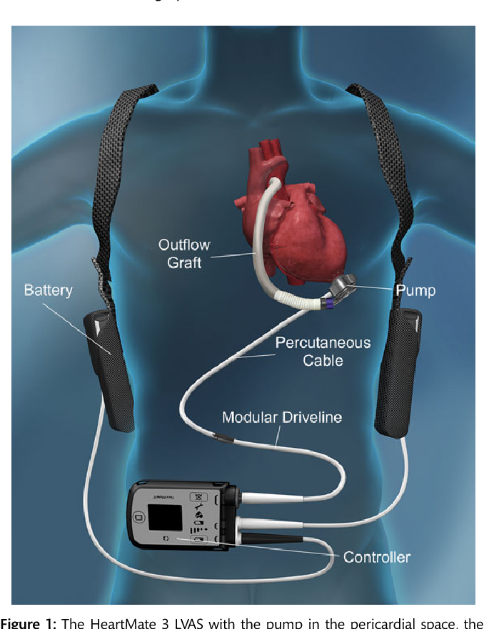 HeartMate 3 LVAD