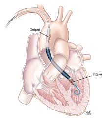 Impella - Bomba Microaxial