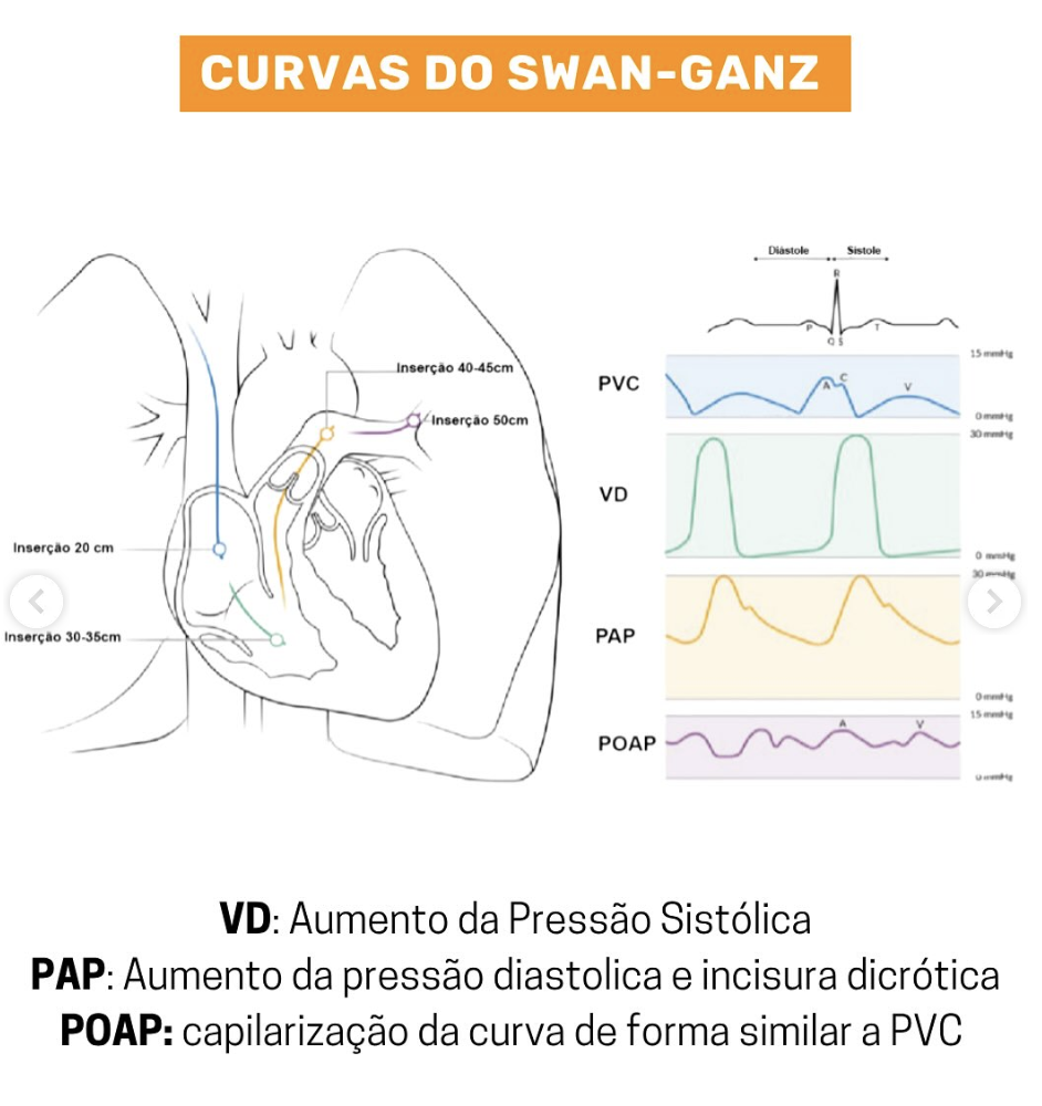 Curvas do Swan-Ganz